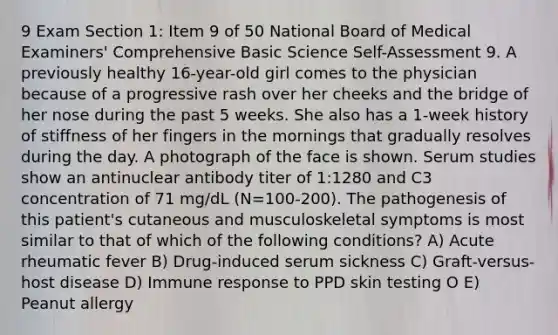 9 Exam Section 1: Item 9 of 50 National Board of Medical Examiners' Comprehensive Basic Science Self-Assessment 9. A previously healthy 16-year-old girl comes to the physician because of a progressive rash over her cheeks and the bridge of her nose during the past 5 weeks. She also has a 1-week history of stiffness of her fingers in the mornings that gradually resolves during the day. A photograph of the face is shown. Serum studies show an antinuclear antibody titer of 1:1280 and C3 concentration of 71 mg/dL (N=100-200). The pathogenesis of this patient's cutaneous and musculoskeletal symptoms is most similar to that of which of the following conditions? A) Acute rheumatic fever B) Drug-induced serum sickness C) Graft-versus-host disease D) Immune response to PPD skin testing O E) Peanut allergy