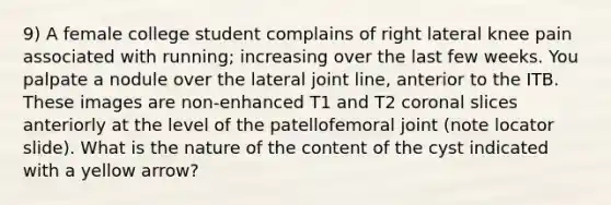 9) A female college student complains of right lateral knee pain associated with running; increasing over the last few weeks. You palpate a nodule over the lateral joint line, anterior to the ITB. These images are non-enhanced T1 and T2 coronal slices anteriorly at the level of the patellofemoral joint (note locator slide). What is the nature of the content of the cyst indicated with a yellow arrow?