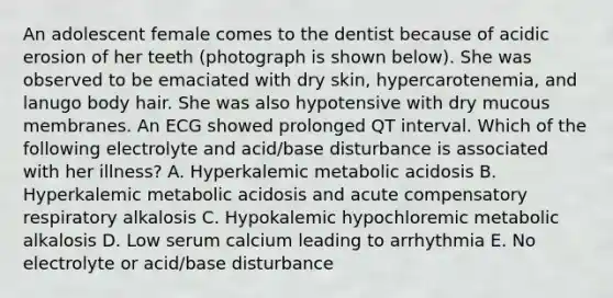 An adolescent female comes to the dentist because of acidic erosion of her teeth (photograph is shown below). She was observed to be emaciated with dry skin, hypercarotenemia, and lanugo body hair. She was also hypotensive with dry mucous membranes. An ECG showed prolonged QT interval. Which of the following electrolyte and acid/base disturbance is associated with her illness? A. Hyperkalemic metabolic acidosis B. Hyperkalemic metabolic acidosis and acute compensatory respiratory alkalosis C. Hypokalemic hypochloremic metabolic alkalosis D. Low serum calcium leading to arrhythmia E. No electrolyte or acid/base disturbance