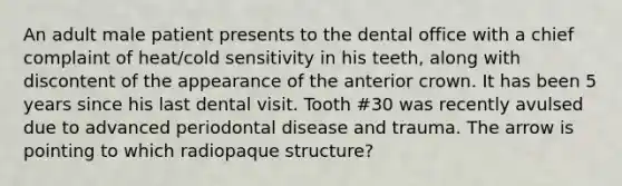 An adult male patient presents to the dental office with a chief complaint of heat/cold sensitivity in his teeth, along with discontent of the appearance of the anterior crown. It has been 5 years since his last dental visit. Tooth #30 was recently avulsed due to advanced periodontal disease and trauma. The arrow is pointing to which radiopaque structure?