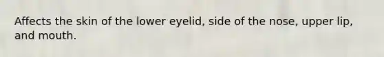 Affects the skin of the lower eyelid, side of the nose, upper lip, and mouth.