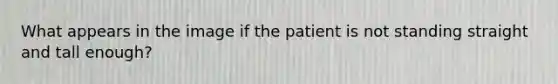 What appears in the image if the patient is not standing straight and tall enough?