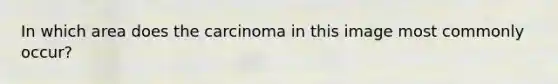In which area does the carcinoma in this image most commonly occur?