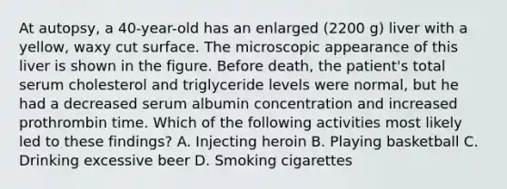 At autopsy, a 40-year-old has an enlarged (2200 g) liver with a yellow, waxy cut surface. The microscopic appearance of this liver is shown in the figure. Before death, the patient's total serum cholesterol and triglyceride levels were normal, but he had a decreased serum albumin concentration and increased prothrombin time. Which of the following activities most likely led to these findings? A. Injecting heroin B. Playing basketball C. Drinking excessive beer D. Smoking cigarettes