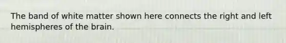 The band of white matter shown here connects the right and left hemispheres of the brain.