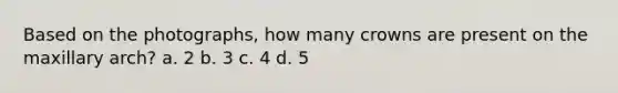 Based on the photographs, how many crowns are present on the maxillary arch? a. 2 b. 3 c. 4 d. 5