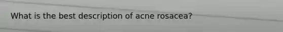 What is the best description of acne rosacea?