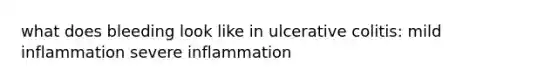 what does bleeding look like in ulcerative colitis: mild inflammation severe inflammation