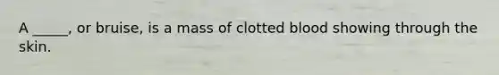 A _____, or bruise, is a mass of clotted blood showing through the skin.