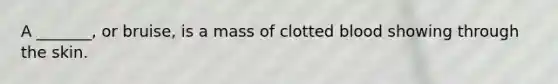 A _______, or bruise, is a mass of clotted blood showing through the skin.