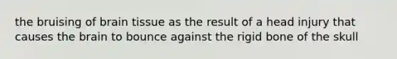 the bruising of brain tissue as the result of a head injury that causes the brain to bounce against the rigid bone of the skull