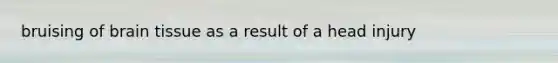 bruising of brain tissue as a result of a head injury
