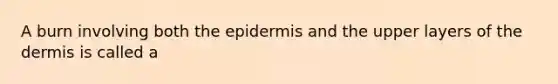 A burn involving both the epidermis and the upper layers of the dermis is called a