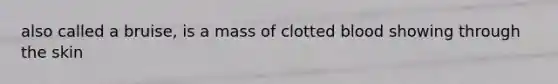 also called a bruise, is a mass of clotted blood showing through the skin