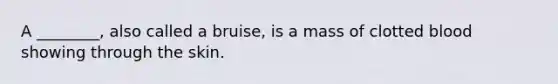 A ________, also called a bruise, is a mass of clotted blood showing through the skin.