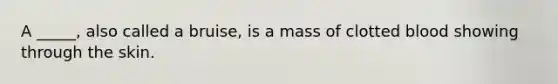 A _____, also called a bruise, is a mass of clotted blood showing through the skin.