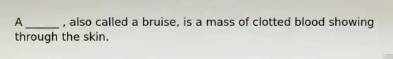 A ______ , also called a bruise, is a mass of clotted blood showing through the skin.