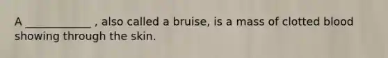 A ____________ , also called a bruise, is a mass of clotted blood showing through the skin.