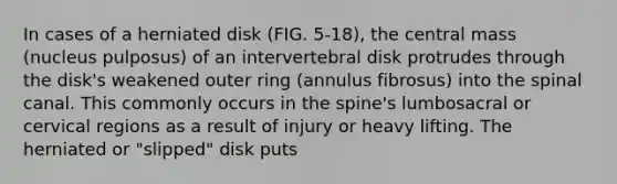 In cases of a herniated disk (FIG. 5-18), the central mass (nucleus pulposus) of an intervertebral disk protrudes through the disk's weakened outer ring (annulus fibrosus) into the spinal canal. This commonly occurs in the spine's lumbosacral or cervical regions as a result of injury or heavy lifting. The herniated or "slipped" disk puts