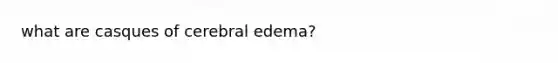 what are casques of cerebral edema?