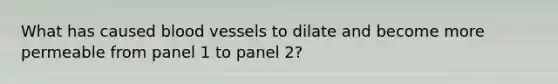 What has caused blood vessels to dilate and become more permeable from panel 1 to panel 2?