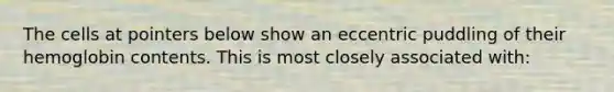 The cells at pointers below show an eccentric puddling of their hemoglobin contents. This is most closely associated with: