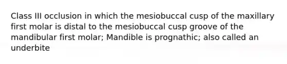 Class III occlusion in which the mesiobuccal cusp of the maxillary first molar is distal to the mesiobuccal cusp groove of the mandibular first molar; Mandible is prognathic; also called an underbite