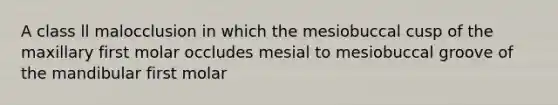 A class ll malocclusion in which the mesiobuccal cusp of the maxillary first molar occludes mesial to mesiobuccal groove of the mandibular first molar