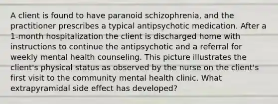 A client is found to have paranoid schizophrenia, and the practitioner prescribes a typical antipsychotic medication. After a 1-month hospitalization the client is discharged home with instructions to continue the antipsychotic and a referral for weekly mental health counseling. This picture illustrates the client's physical status as observed by the nurse on the client's first visit to the community mental health clinic. What extrapyramidal side effect has developed?