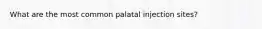 What are the most common palatal injection sites?