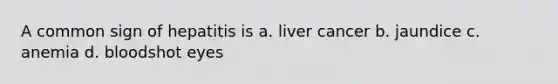 A common sign of hepatitis is a. liver cancer b. jaundice c. anemia d. bloodshot eyes