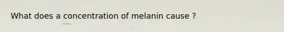 What does a concentration of melanin cause ?