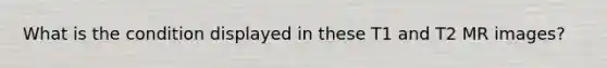 What is the condition displayed in these T1 and T2 MR images?