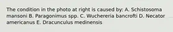 The condition in the photo at right is caused by: A. Schistosoma mansoni B. Paragonimus spp. C. Wuchereria bancrofti D. Necator americanus E. Dracunculus medinensis