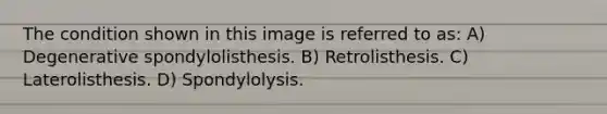 The condition shown in this image is referred to as: A) Degenerative spondylolisthesis. B) Retrolisthesis. C) Laterolisthesis. D) Spondylolysis.