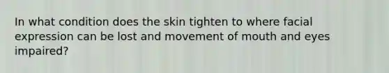 In what condition does the skin tighten to where facial expression can be lost and movement of mouth and eyes impaired?