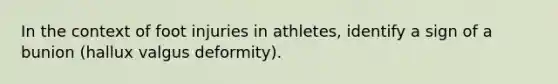 In the context of foot injuries in athletes, identify a sign of a bunion (hallux valgus deformity).