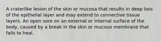 A craterlike lesion of the skin or mucosa that results in deep loss of the epithelial layer and may extend to connective tissue layers. An open sore on an external or internal surface of the body, caused by a break in the skin or mucous membrane that fails to heal.