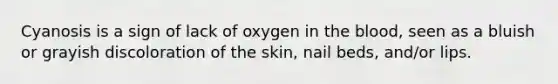 Cyanosis is a sign of lack of oxygen in the blood, seen as a bluish or grayish discoloration of the skin, nail beds, and/or lips.