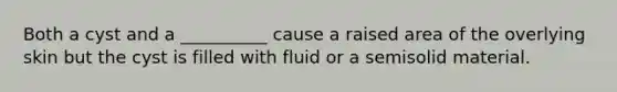 Both a cyst and a __________ cause a raised area of the overlying skin but the cyst is filled with fluid or a semisolid material.