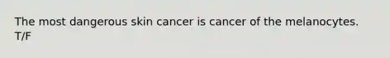 The most dangerous skin cancer is cancer of the melanocytes. T/F