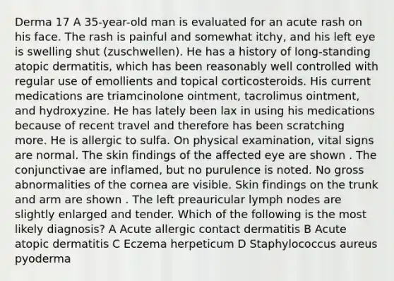 Derma 17 A 35-year-old man is evaluated for an acute rash on his face. The rash is painful and somewhat itchy, and his left eye is swelling shut (zuschwellen). He has a history of long-standing atopic dermatitis, which has been reasonably well controlled with regular use of emollients and topical corticosteroids. His current medications are triamcinolone ointment, tacrolimus ointment, and hydroxyzine. He has lately been lax in using his medications because of recent travel and therefore has been scratching more. He is allergic to sulfa. On physical examination, vital signs are normal. The skin findings of the affected eye are shown . The conjunctivae are inflamed, but no purulence is noted. No gross abnormalities of the cornea are visible. Skin findings on the trunk and arm are shown . The left preauricular lymph nodes are slightly enlarged and tender. Which of the following is the most likely diagnosis? A Acute allergic contact dermatitis B Acute atopic dermatitis C Eczema herpeticum D Staphylococcus aureus pyoderma