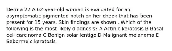 Derma 22 A 62-year-old woman is evaluated for an asymptomatic pigmented patch on her cheek that has been present for 15 years. Skin findings are shown . Which of the following is the most likely diagnosis? A Actinic keratosis B Basal cell carcinoma C Benign solar lentigo D Malignant melanoma E Seborrheic keratosis