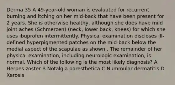 Derma 35 A 49-year-old woman is evaluated for recurrent burning and itching on her mid-back that have been present for 2 years. She is otherwise healthy, although she does have mild joint aches (Schmerzen) (neck, lower back, knees) for which she uses ibuprofen intermittently. Physical examination discloses ill-defined hyperpigmented patches on the mid-back below the medial aspect of the scapulae as shown . The remainder of her physical examination, including neurologic examination, is normal. Which of the following is the most likely diagnosis? A Herpes zoster B Notalgia paresthetica C Nummular dermatitis D Xerosis