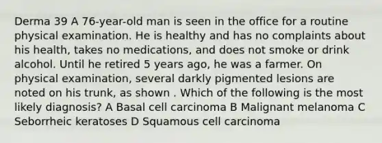 Derma 39 A 76-year-old man is seen in the office for a routine physical examination. He is healthy and has no complaints about his health, takes no medications, and does not smoke or drink alcohol. Until he retired 5 years ago, he was a farmer. On physical examination, several darkly pigmented lesions are noted on his trunk, as shown . Which of the following is the most likely diagnosis? A Basal cell carcinoma B Malignant melanoma C Seborrheic keratoses D Squamous cell carcinoma