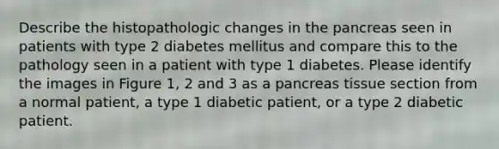 Describe the histopathologic changes in the pancreas seen in patients with type 2 diabetes mellitus and compare this to the pathology seen in a patient with type 1 diabetes. Please identify the images in Figure 1, 2 and 3 as a pancreas tissue section from a normal patient, a type 1 diabetic patient, or a type 2 diabetic patient.