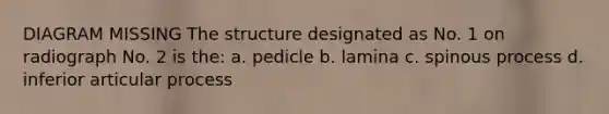 DIAGRAM MISSING The structure designated as No. 1 on radiograph No. 2 is the: a. pedicle b. lamina c. spinous process d. inferior articular process