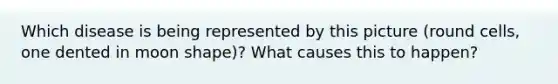 Which disease is being represented by this picture (round cells, one dented in moon shape)? What causes this to happen?