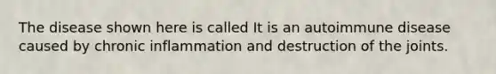 The disease shown here is called It is an autoimmune disease caused by chronic inflammation and destruction of the joints.