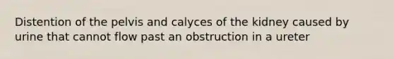 Distention of the pelvis and calyces of the kidney caused by urine that cannot flow past an obstruction in a ureter